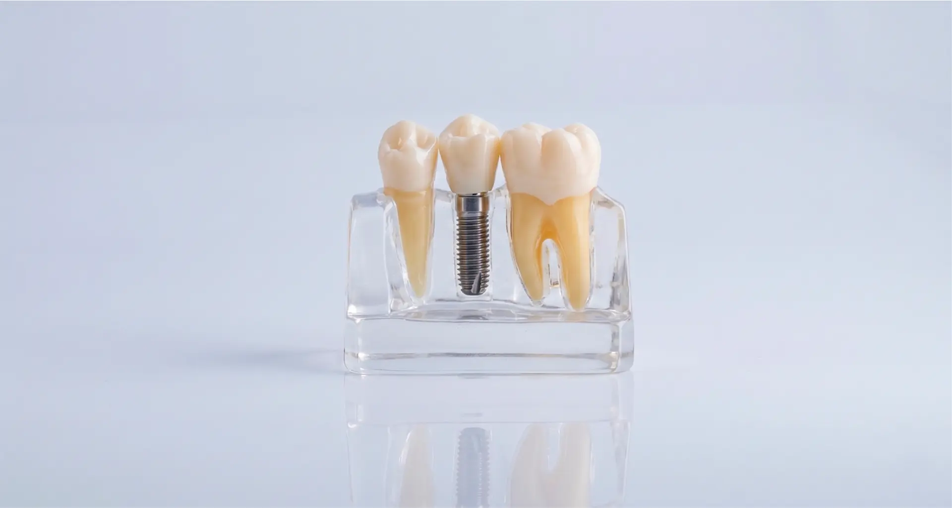 Implantes Dentales