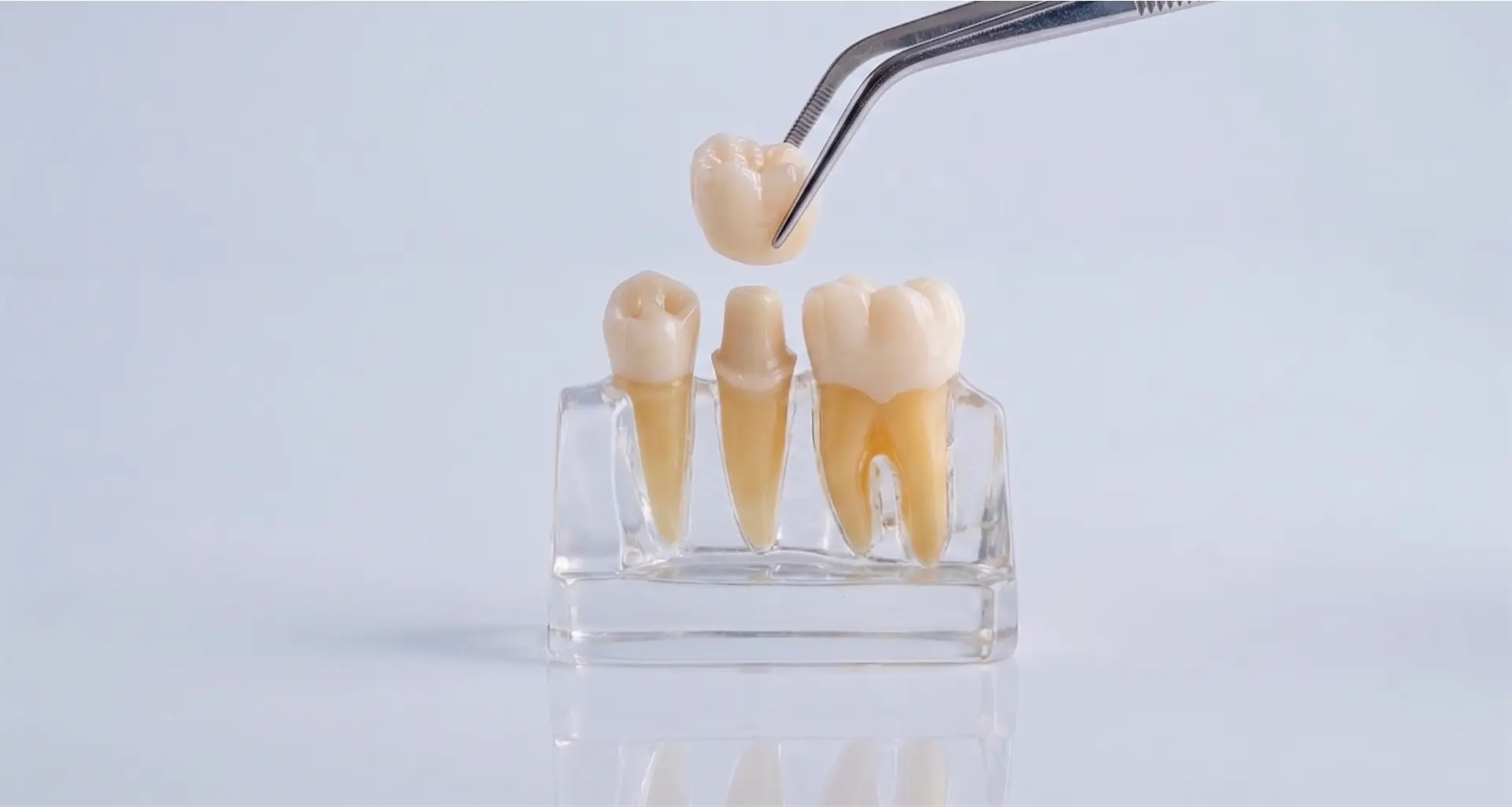 Coronas de Zirconia