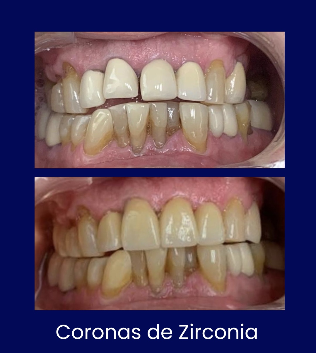 Coronas de Zirconia