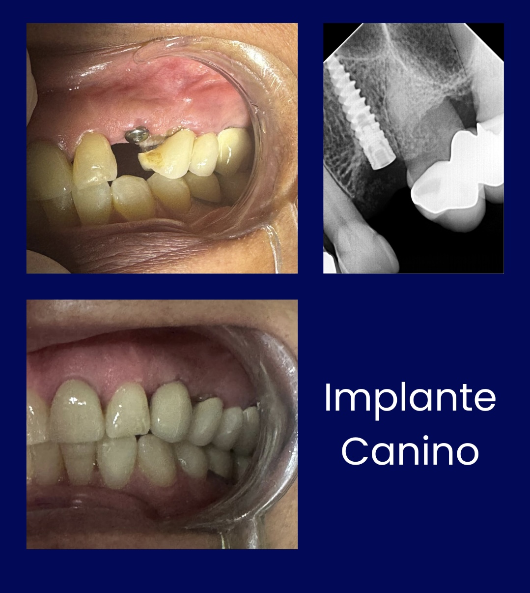 Implante Canino