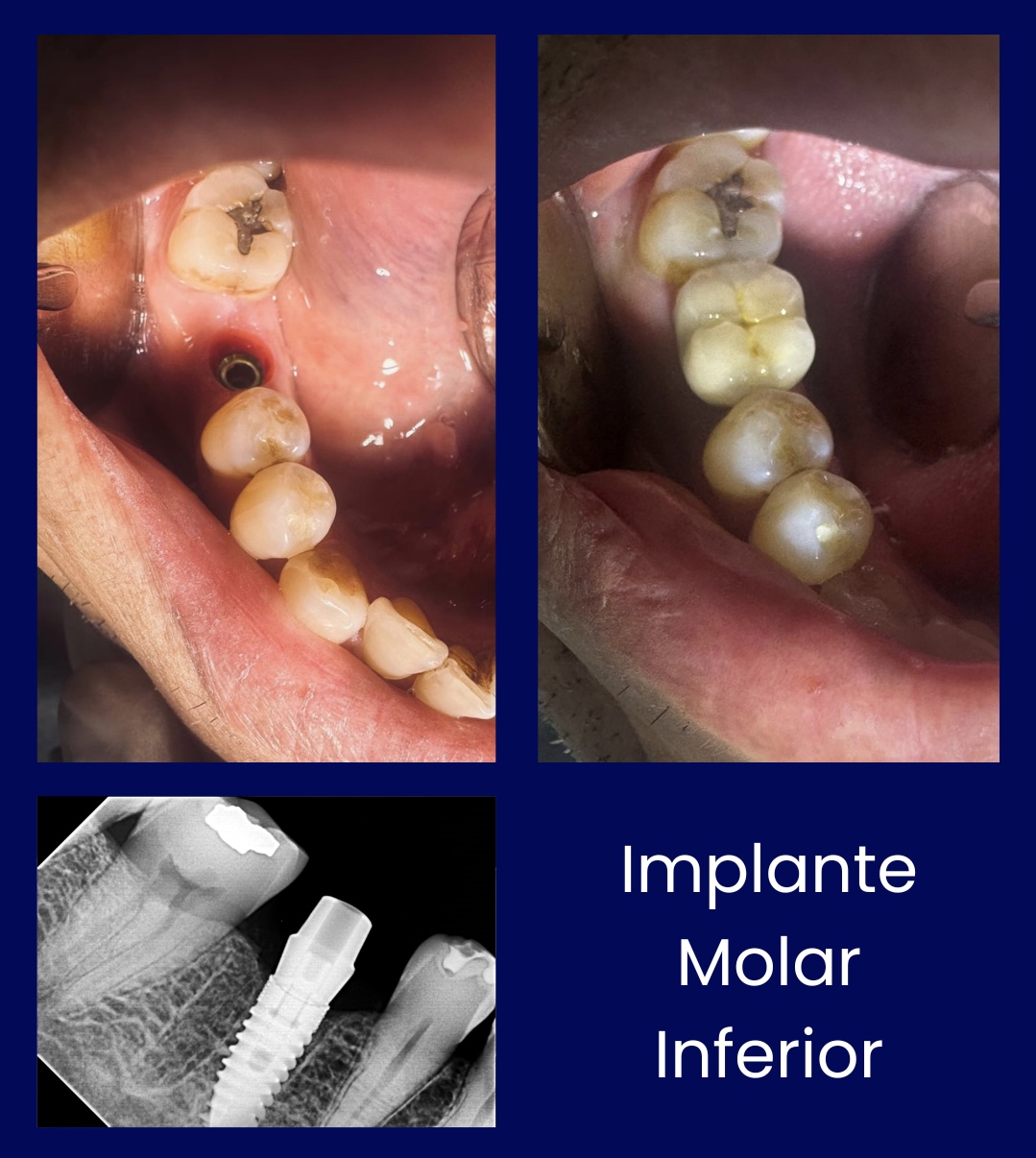 Implante Molar Inferior