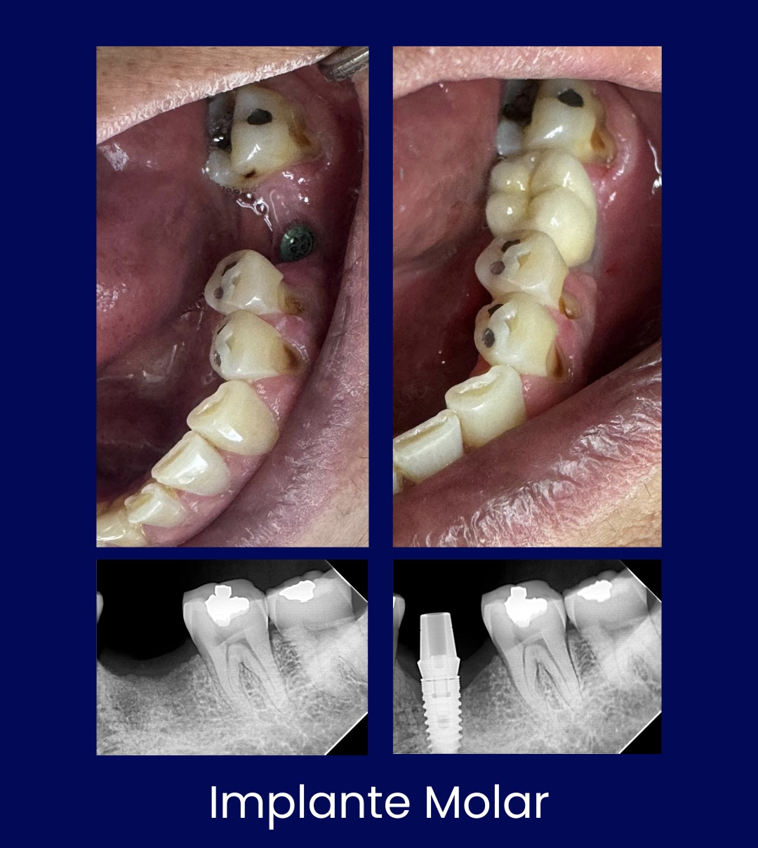 Implante Molar