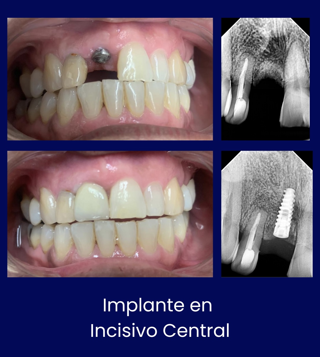 Implante en Incisivo Central