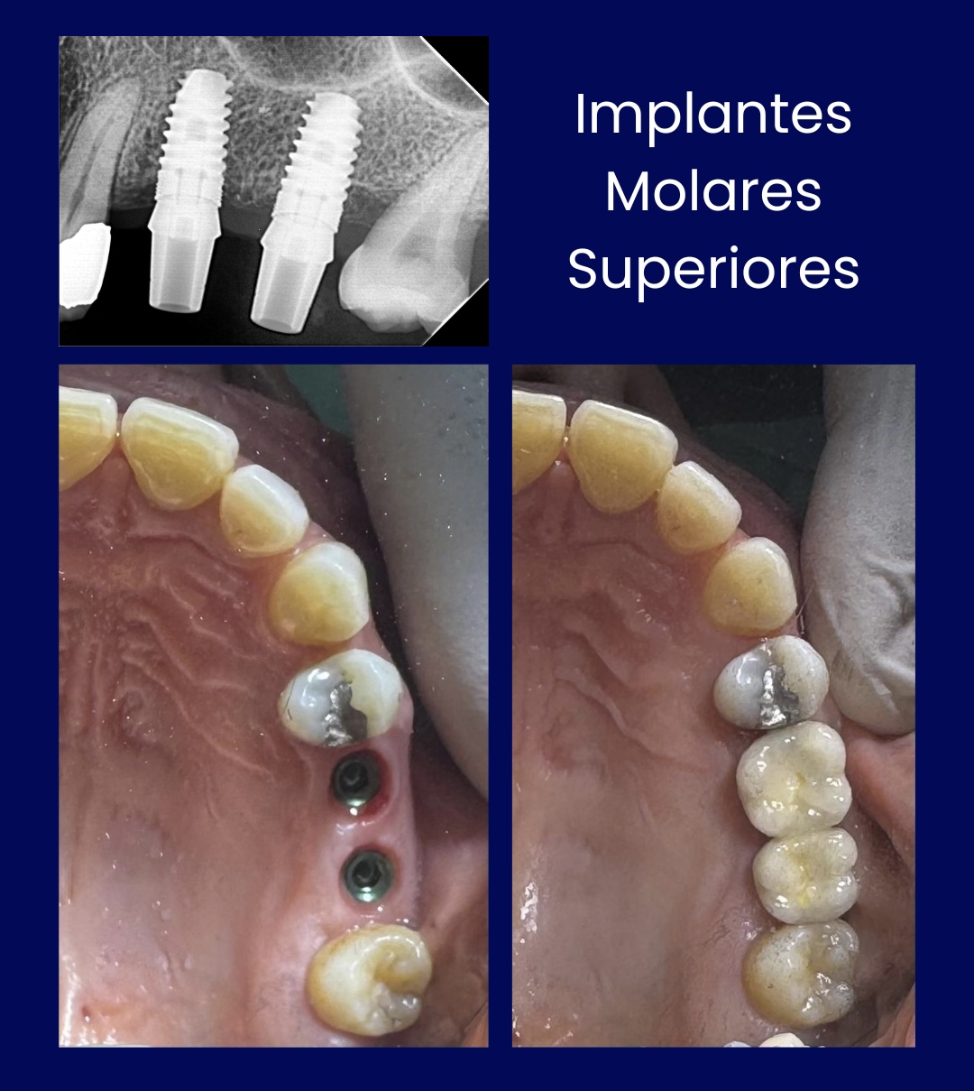 Implantes Molares Superiores