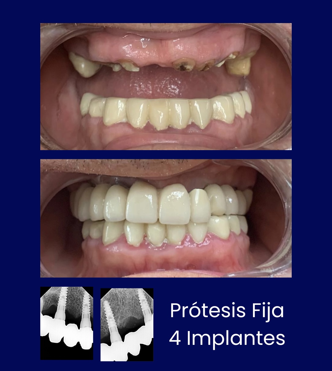 Protesis Fija 4 Implantes