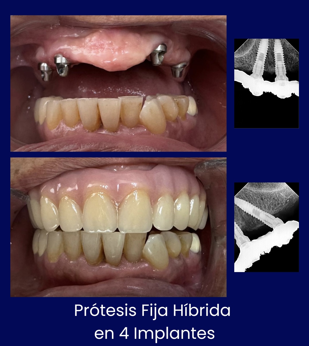 Prótesis Fija Híbrida en 4 Implantes