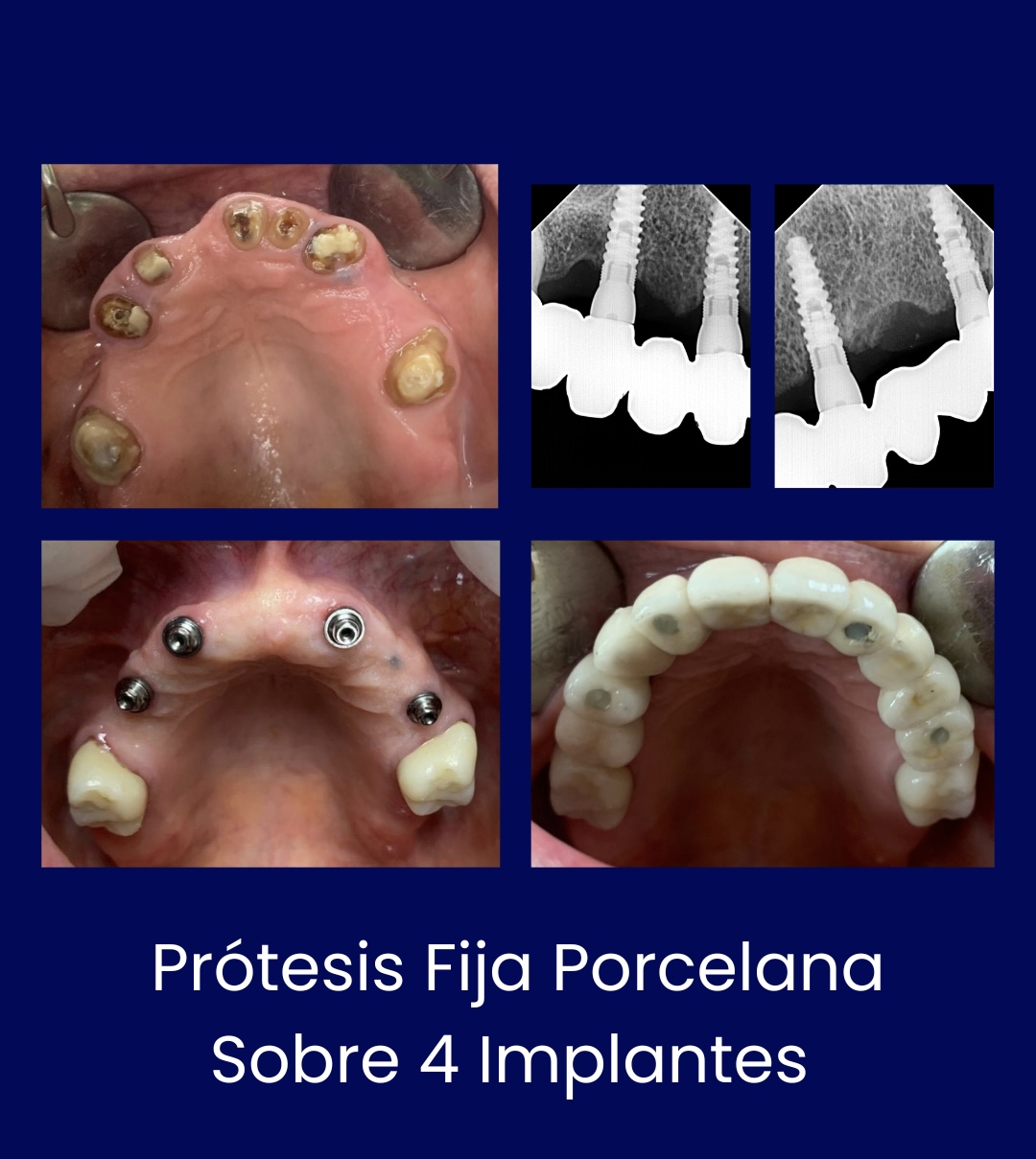 Protesis Fija Porcelana 4 Implantes